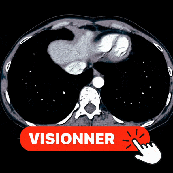 pourquoi 33 séances de radiothérapie prostate